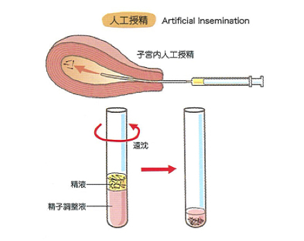 人工授精