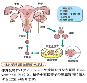 卵 管 造影 検査 後 性行為 いつから