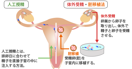 人工授精と体外受精